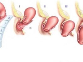 Sa tử cung sau sinh – Nỗi lo của mẹ bỉm và cách khắc phục an toàn