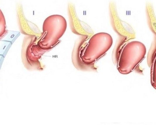Sa tử cung sau sinh – Nỗi lo của mẹ bỉm và cách khắc phục an toàn