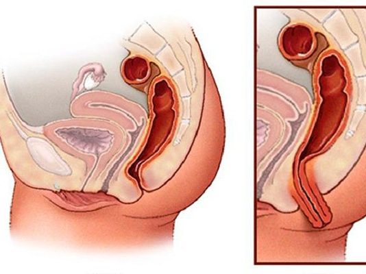 Sa tử cung là gì? Nguyên nhân, triệu chứng và cách điều trị hiệu quả