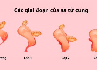 Các cấp độ sa tử cung và hướng điều trị tương ứng