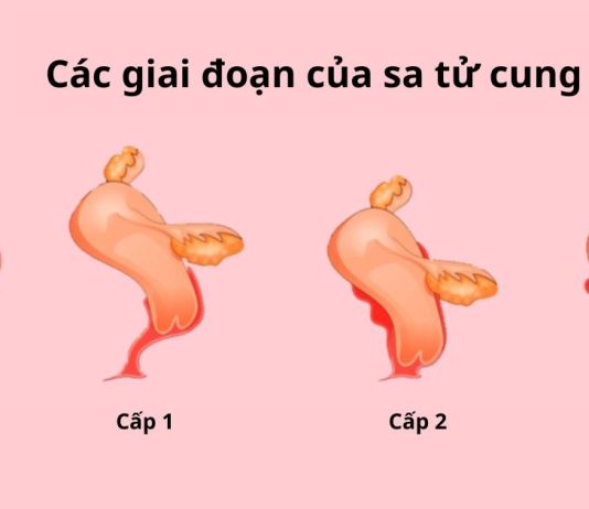 Các cấp độ sa tử cung và hướng điều trị tương ứng